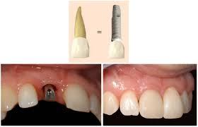 Cấy ghép răng (Implant)