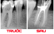 Chữa tủy răng